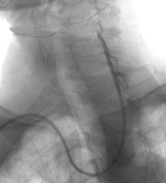 动脉长鞘怎么置入【康德莱医械】经桡介入LA长鞘+Sim II通路组合处理颈内动脉狭窄_https://www.jmylbn.com_新闻资讯_第19张