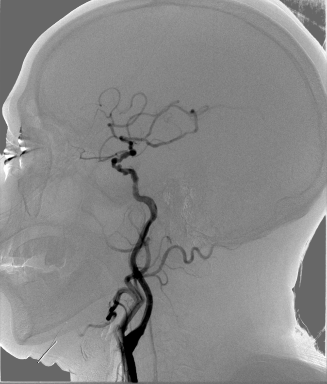动脉长鞘怎么置入【康德莱医械】经桡介入LA长鞘+Sim II通路组合处理颈内动脉狭窄_https://www.jmylbn.com_新闻资讯_第10张