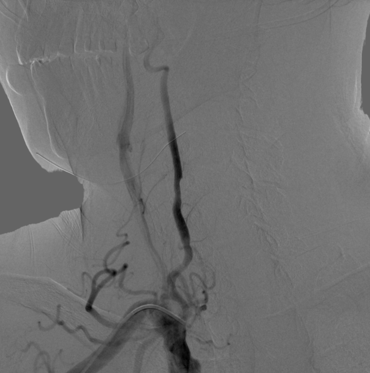动脉长鞘怎么置入【康德莱医械】经桡介入LA长鞘+Sim II通路组合处理颈内动脉狭窄_https://www.jmylbn.com_新闻资讯_第14张