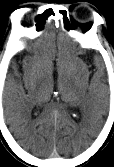 动脉长鞘怎么置入【康德莱医械】经桡介入LA长鞘+Sim II通路组合处理颈内动脉狭窄_https://www.jmylbn.com_新闻资讯_第4张