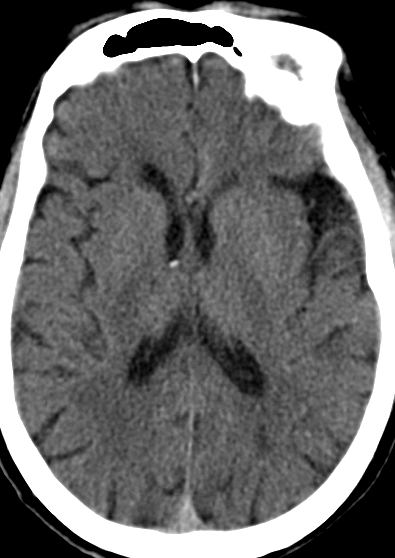 动脉长鞘怎么置入【康德莱医械】经桡介入LA长鞘+Sim II通路组合处理颈内动脉狭窄_https://www.jmylbn.com_新闻资讯_第5张