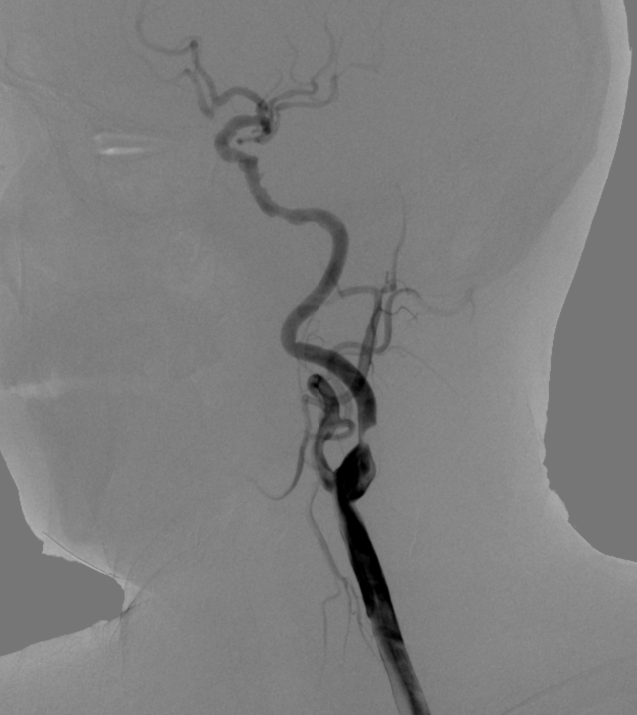 动脉长鞘怎么置入【康德莱医械】经桡介入LA长鞘+Sim II通路组合处理颈内动脉狭窄_https://www.jmylbn.com_新闻资讯_第8张
