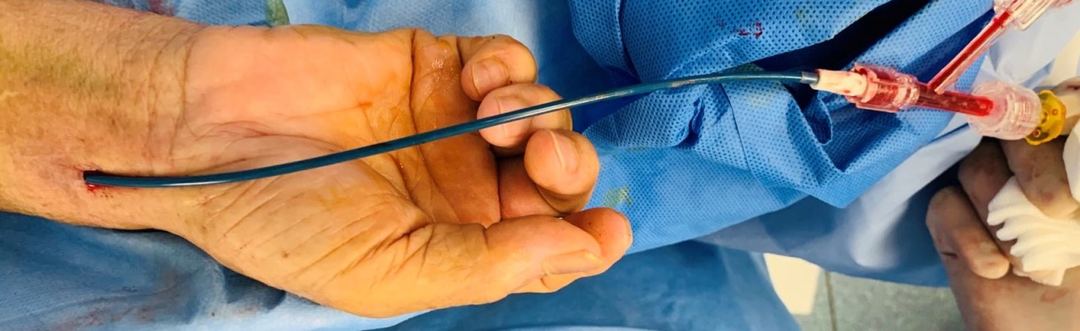 动脉长鞘怎么置入【康德莱医械】经桡介入LA长鞘+Sim II通路组合处理颈内动脉狭窄_https://www.jmylbn.com_新闻资讯_第18张