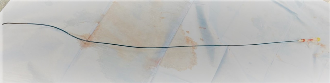 动脉长鞘怎么置入【康德莱医械】经桡介入LA长鞘+Sim II通路组合处理颈内动脉狭窄_https://www.jmylbn.com_新闻资讯_第22张