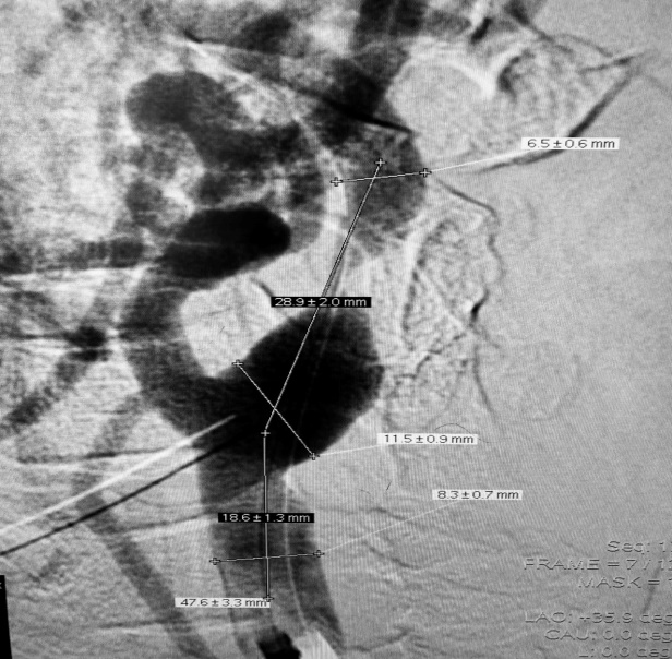动脉长鞘怎么置入【康德莱医械】经桡介入LA长鞘+Sim II通路组合处理颈内动脉狭窄_https://www.jmylbn.com_新闻资讯_第20张