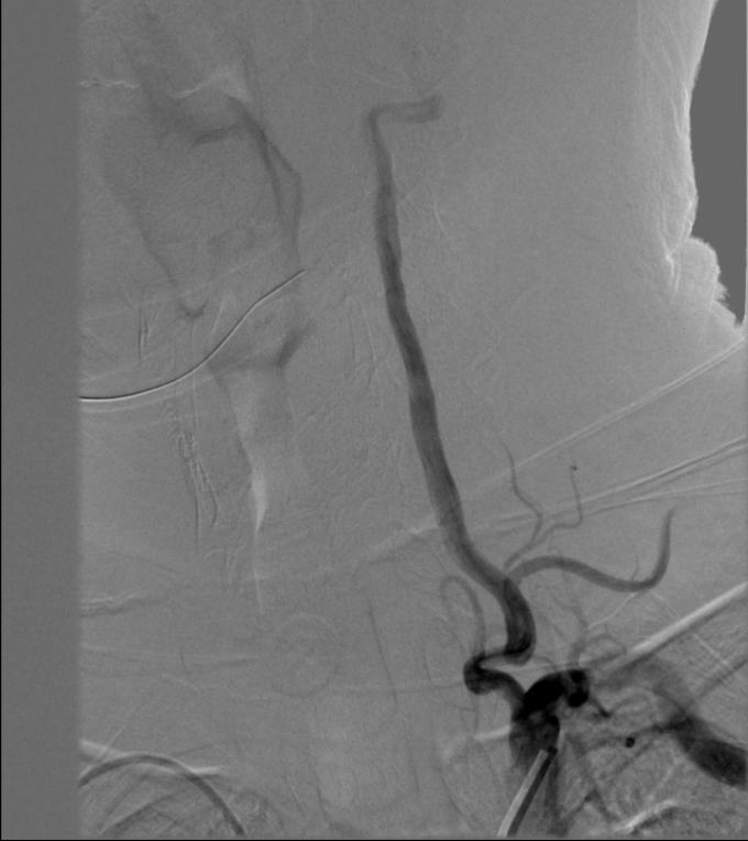 动脉长鞘怎么置入【康德莱医械】经桡介入LA长鞘+Sim II通路组合处理颈内动脉狭窄_https://www.jmylbn.com_新闻资讯_第12张