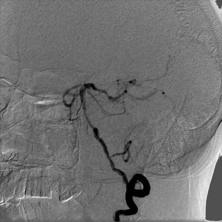 动脉长鞘怎么置入【康德莱医械】经桡介入LA长鞘+Sim II通路组合处理颈内动脉狭窄_https://www.jmylbn.com_新闻资讯_第13张