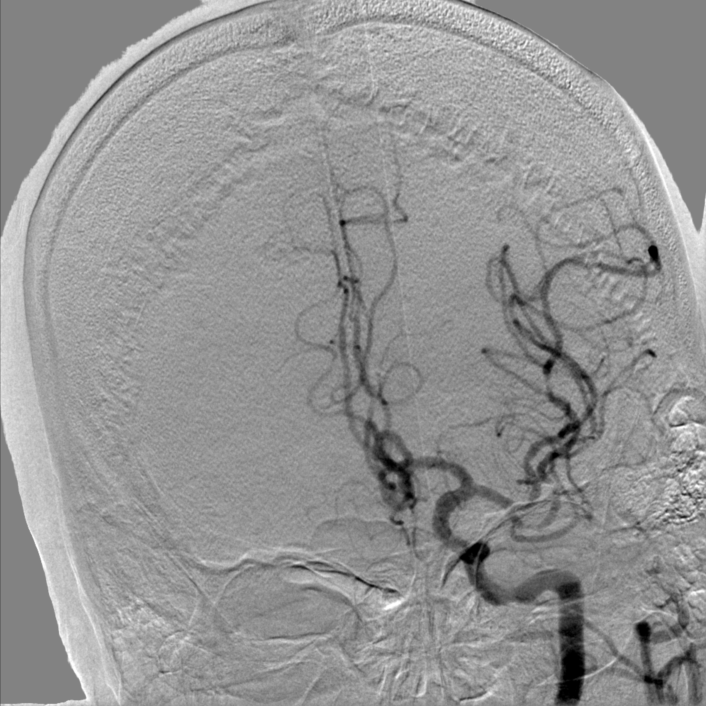 动脉长鞘怎么置入【康德莱医械】经桡介入LA长鞘+Sim II通路组合处理颈内动脉狭窄_https://www.jmylbn.com_新闻资讯_第9张