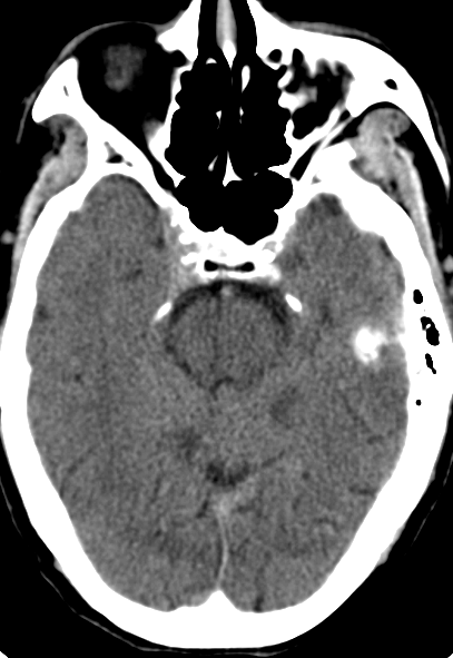 动脉长鞘怎么置入【康德莱医械】经桡介入LA长鞘+Sim II通路组合处理颈内动脉狭窄_https://www.jmylbn.com_新闻资讯_第3张