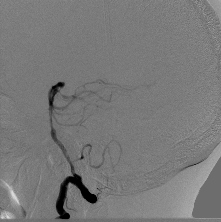 动脉长鞘怎么置入【康德莱医械】经桡介入LA长鞘+Sim II通路组合处理颈内动脉狭窄_https://www.jmylbn.com_新闻资讯_第15张
