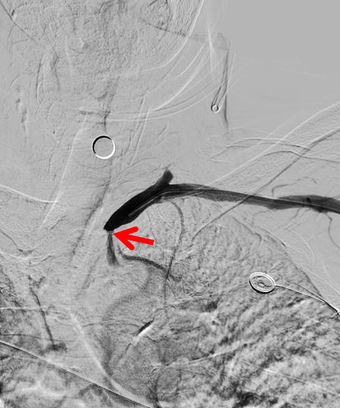 动脉长鞘怎么置入健谈卒中｜张志勇教授：伐竹取道，另辟蹊径  一例桡动脉入路经NeuronMax长鞘行左侧锁骨下动脉支架置入治疗_https://www.jmylbn.com_新闻资讯_第9张