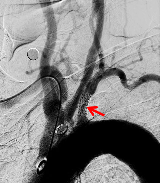 动脉长鞘怎么置入健谈卒中｜张志勇教授：伐竹取道，另辟蹊径  一例桡动脉入路经NeuronMax长鞘行左侧锁骨下动脉支架置入治疗_https://www.jmylbn.com_新闻资讯_第14张