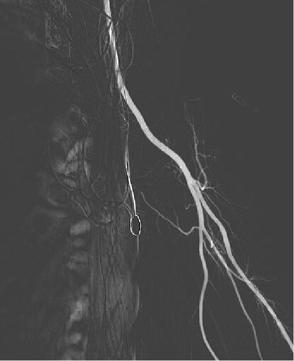 动脉长鞘怎么置入健谈卒中｜张志勇教授：伐竹取道，另辟蹊径  一例桡动脉入路经NeuronMax长鞘行左侧锁骨下动脉支架置入治疗_https://www.jmylbn.com_新闻资讯_第8张