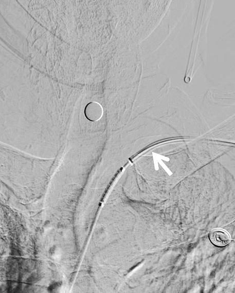 动脉长鞘怎么置入健谈卒中｜张志勇教授：伐竹取道，另辟蹊径  一例桡动脉入路经NeuronMax长鞘行左侧锁骨下动脉支架置入治疗_https://www.jmylbn.com_新闻资讯_第10张