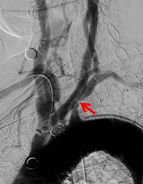 动脉长鞘怎么置入健谈卒中｜张志勇教授：伐竹取道，另辟蹊径  一例桡动脉入路经NeuronMax长鞘行左侧锁骨下动脉支架置入治疗_https://www.jmylbn.com_新闻资讯_第7张