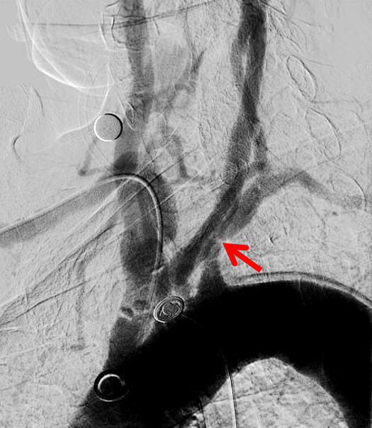 动脉长鞘怎么置入健谈卒中｜张志勇教授：伐竹取道，另辟蹊径  一例桡动脉入路经NeuronMax长鞘行左侧锁骨下动脉支架置入治疗_https://www.jmylbn.com_新闻资讯_第13张