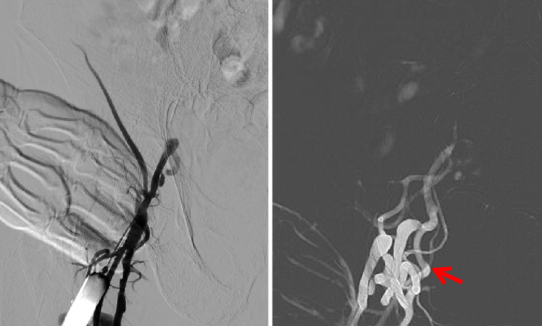 动脉长鞘怎么置入健谈卒中｜张志勇教授：伐竹取道，另辟蹊径  一例桡动脉入路经NeuronMax长鞘行左侧锁骨下动脉支架置入治疗_https://www.jmylbn.com_新闻资讯_第5张