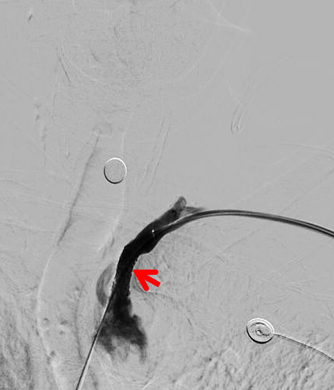 动脉长鞘怎么置入健谈卒中｜张志勇教授：伐竹取道，另辟蹊径  一例桡动脉入路经NeuronMax长鞘行左侧锁骨下动脉支架置入治疗_https://www.jmylbn.com_新闻资讯_第12张