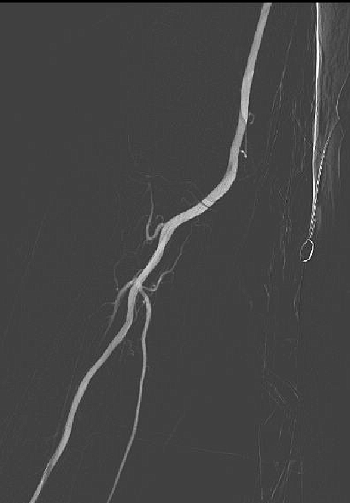 动脉长鞘怎么置入健谈卒中｜张志勇教授：伐竹取道，另辟蹊径  一例桡动脉入路经NeuronMax长鞘行左侧锁骨下动脉支架置入治疗_https://www.jmylbn.com_新闻资讯_第6张