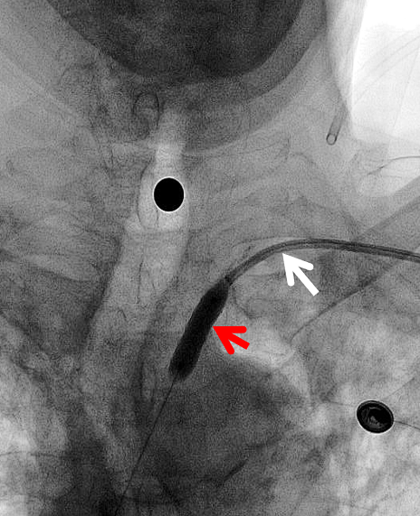 动脉长鞘怎么置入健谈卒中｜张志勇教授：伐竹取道，另辟蹊径  一例桡动脉入路经NeuronMax长鞘行左侧锁骨下动脉支架置入治疗_https://www.jmylbn.com_新闻资讯_第11张