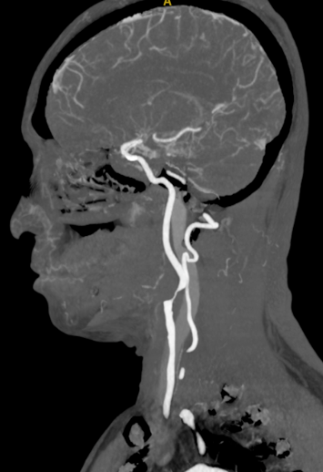 波科支架怎么样径技-弓上病例大赏｜第205期·放疗后症状性颈动脉狭窄支架置入治疗一例_https://www.jmylbn.com_新闻资讯_第11张