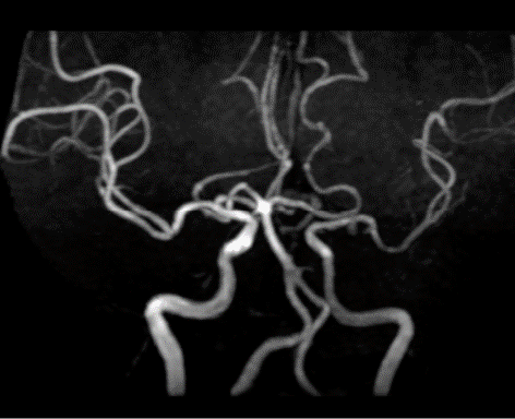 波科支架怎么样径技-弓上病例大赏｜第205期·放疗后症状性颈动脉狭窄支架置入治疗一例_https://www.jmylbn.com_新闻资讯_第5张