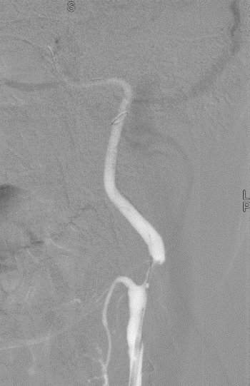波科支架怎么样径技-弓上病例大赏｜第205期·放疗后症状性颈动脉狭窄支架置入治疗一例_https://www.jmylbn.com_新闻资讯_第15张
