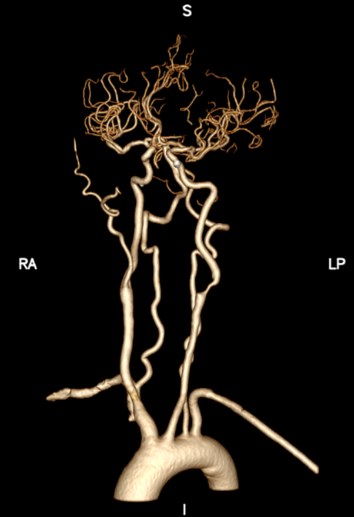 波科支架怎么样径技-弓上病例大赏｜第205期·放疗后症状性颈动脉狭窄支架置入治疗一例_https://www.jmylbn.com_新闻资讯_第9张