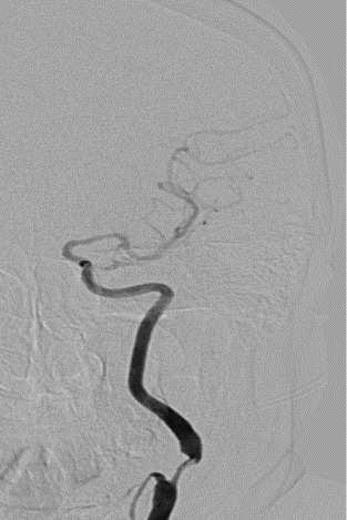 波科支架怎么样径技-弓上病例大赏｜第205期·放疗后症状性颈动脉狭窄支架置入治疗一例_https://www.jmylbn.com_新闻资讯_第13张