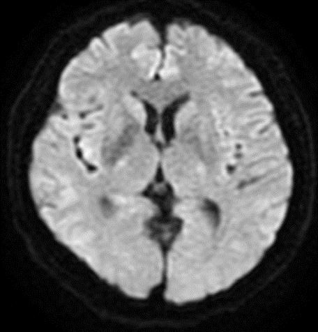 波科支架怎么样径技-弓上病例大赏｜第205期·放疗后症状性颈动脉狭窄支架置入治疗一例_https://www.jmylbn.com_新闻资讯_第3张