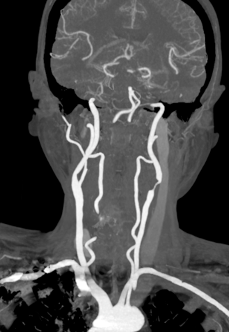 波科支架怎么样径技-弓上病例大赏｜第205期·放疗后症状性颈动脉狭窄支架置入治疗一例_https://www.jmylbn.com_新闻资讯_第10张