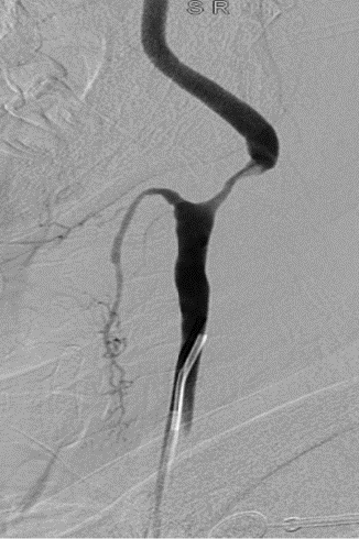 波科支架怎么样径技-弓上病例大赏｜第205期·放疗后症状性颈动脉狭窄支架置入治疗一例_https://www.jmylbn.com_新闻资讯_第14张