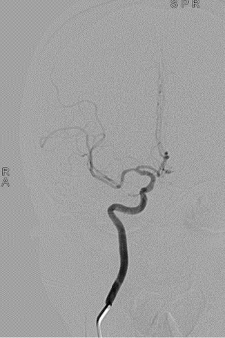 波科支架怎么样径技-弓上病例大赏｜第205期·放疗后症状性颈动脉狭窄支架置入治疗一例_https://www.jmylbn.com_新闻资讯_第12张