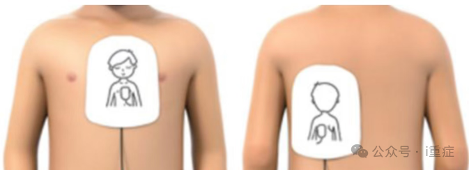 新生儿电极片怎么贴2025年美国AHA心肺复苏指南更新_https://www.jmylbn.com_新闻资讯_第26张