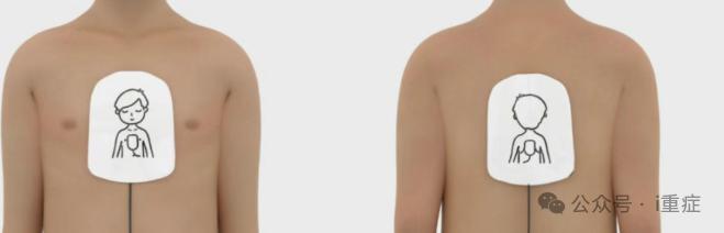 新生儿电极片怎么贴2025年美国AHA心肺复苏指南更新_https://www.jmylbn.com_新闻资讯_第25张