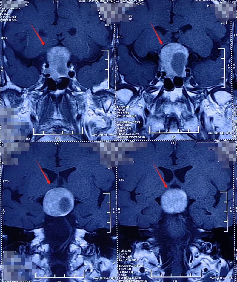 3x33x45厘米06巨大垂体瘤也能经鼻做内镜手术