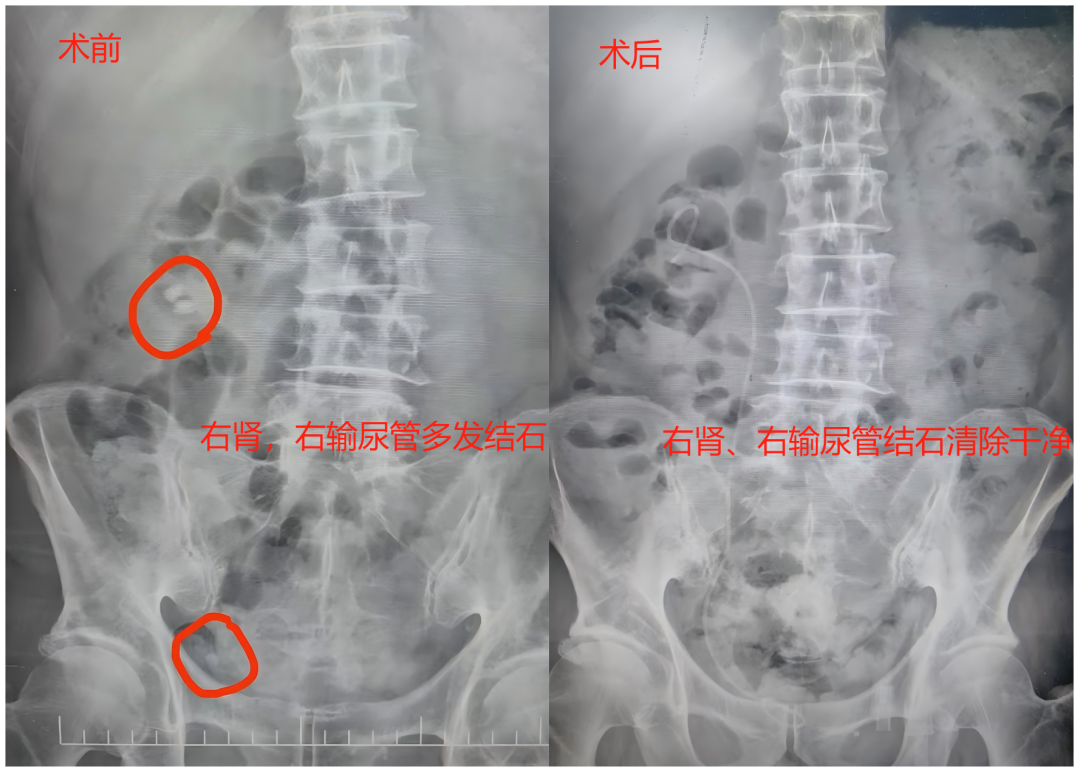 输尿管鞘是什么结石的“狙击手”——输尿管软镜结合前端可弯曲负压吸引鞘清石技术_https://www.jmylbn.com_新闻资讯_第6张