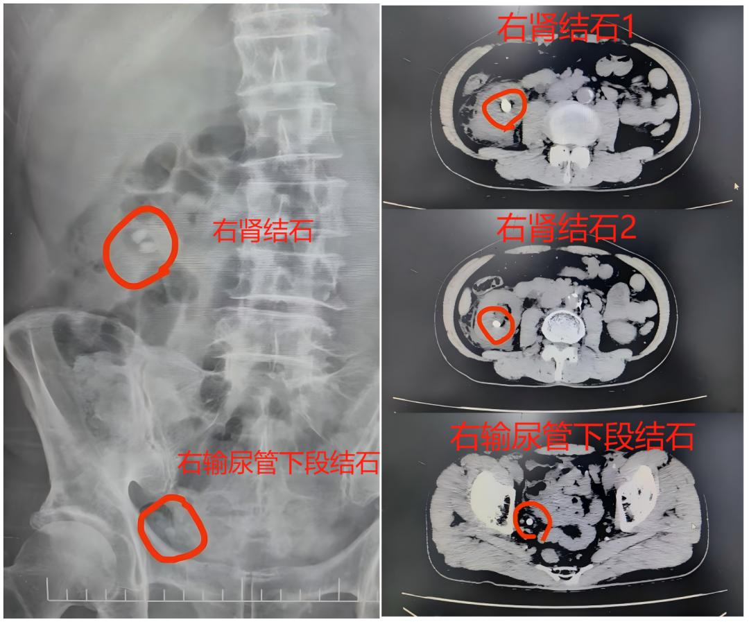 输尿管鞘是什么结石的“狙击手”——输尿管软镜结合前端可弯曲负压吸引鞘清石技术_https://www.jmylbn.com_新闻资讯_第5张