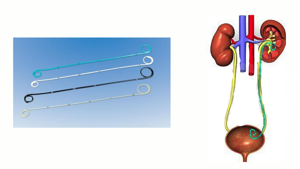 猪输尿管怎么吃医生说我体内有条“猪尾巴管”！_https://www.jmylbn.com_新闻资讯_第5张
