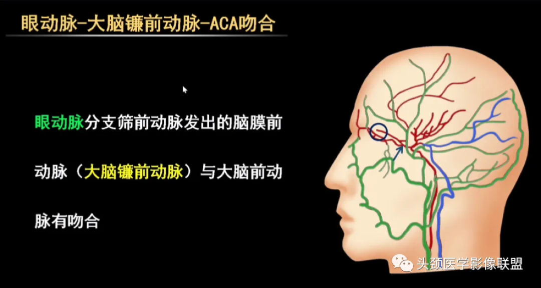 明胶在血管怎么降解前沿文献（第147期）视网膜母细胞瘤动脉内化疗中远端颈外动脉分支的可吸收明胶海绵栓塞_https://www.jmylbn.com_新闻资讯_第5张