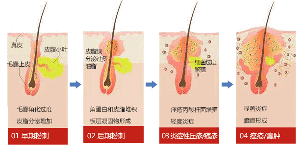 kinglaser激光怎么样医学美容中心：反复长痘痘就是好不了？保姆级战”痘”攻略请收好_https://www.jmylbn.com_新闻资讯_第2张