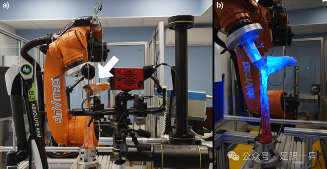 JBJS｜后踝骨折内固定后是否需要额外稳定下胫腓联合？
