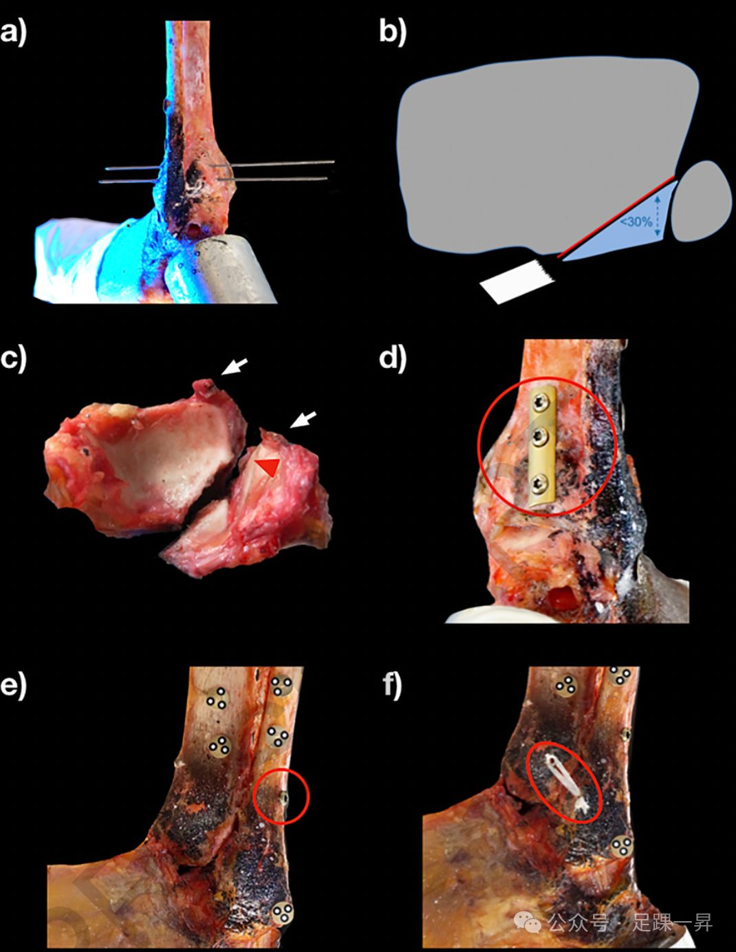 JBJS｜后踝骨折内固定后是否需要额外稳定下胫腓联合？