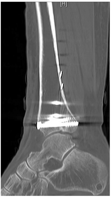 JBJS：后踝骨折、后Pilon骨折及后Pilon变异型骨折的定义与治疗