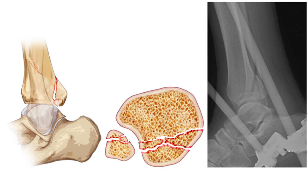 JBJS：后踝骨折、后Pilon骨折及后Pilon变异型骨折的定义与治疗
