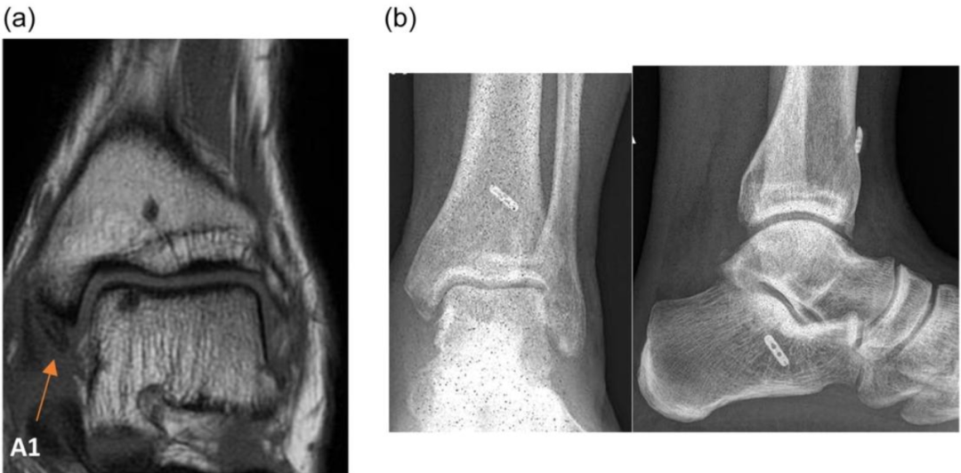 三角韧带损伤：何时修复以及如何修复？