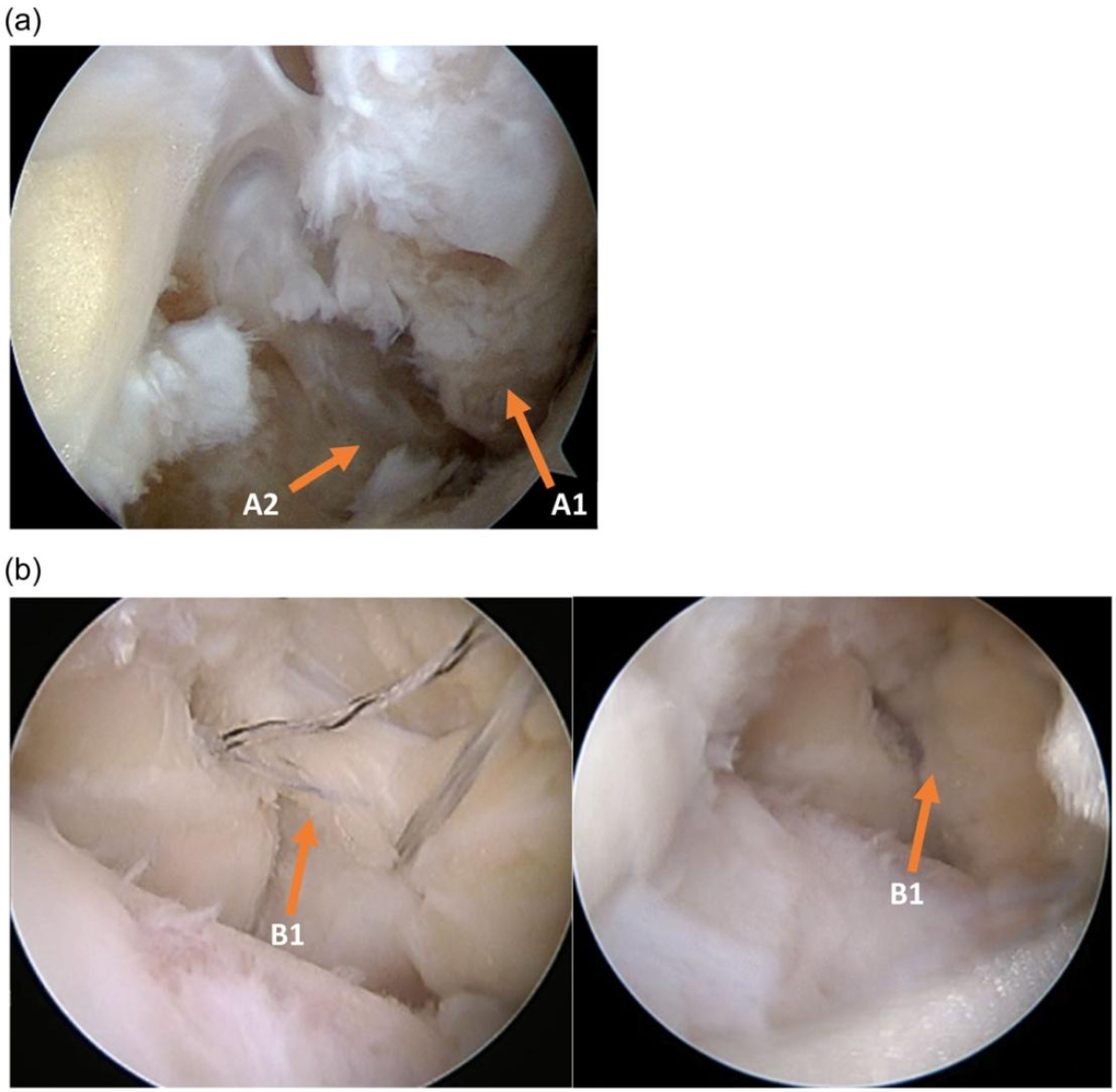 三角韧带损伤：何时修复以及如何修复？