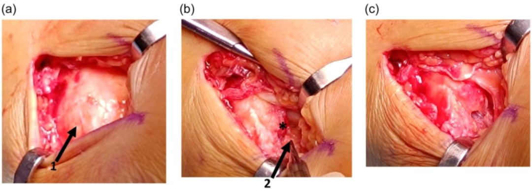 三角韧带损伤：何时修复以及如何修复？