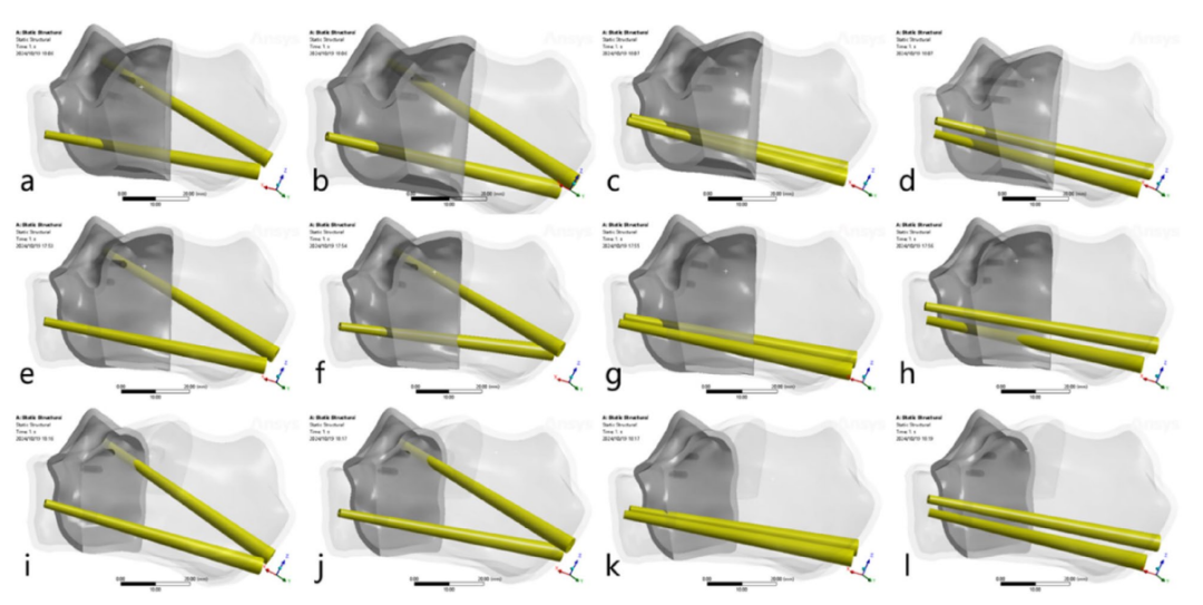 跟骨骨折：微创经皮螺钉固定的最佳螺钉分布及直径