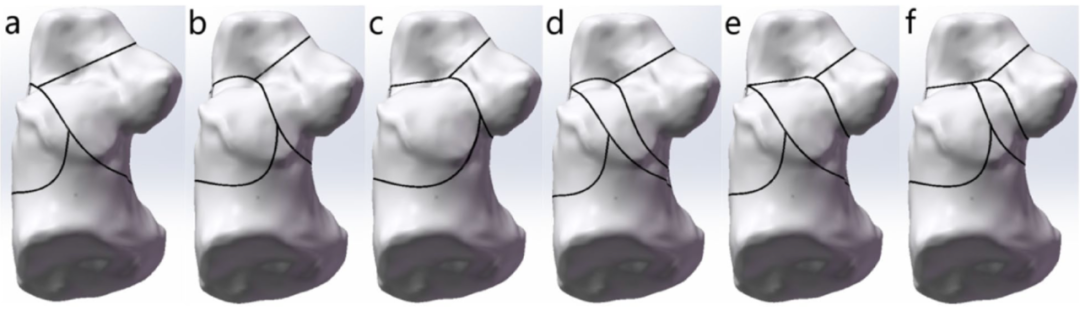 跟骨骨折：微创经皮螺钉固定的最佳螺钉分布及直径
